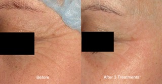 laser-treatment-for-crows-feet-before-and-after-photo