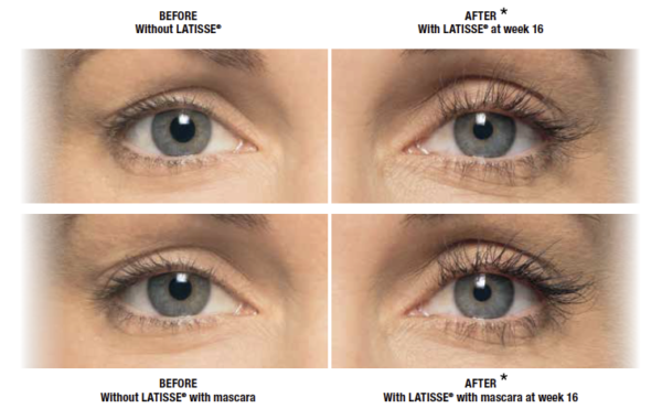 Latisse Eyelash Growth Treatment Orlando, FL