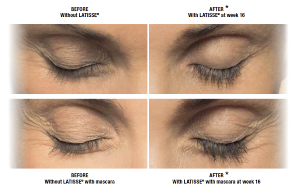 Latisse - Gentle Touch MediSpa