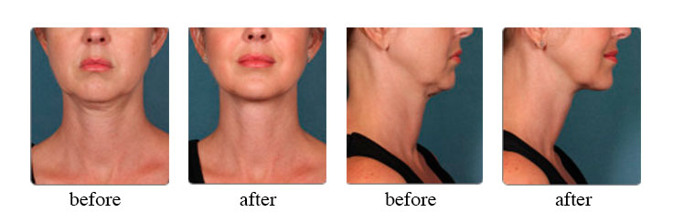 Orlando Kybella Before & After - Gentle Touch