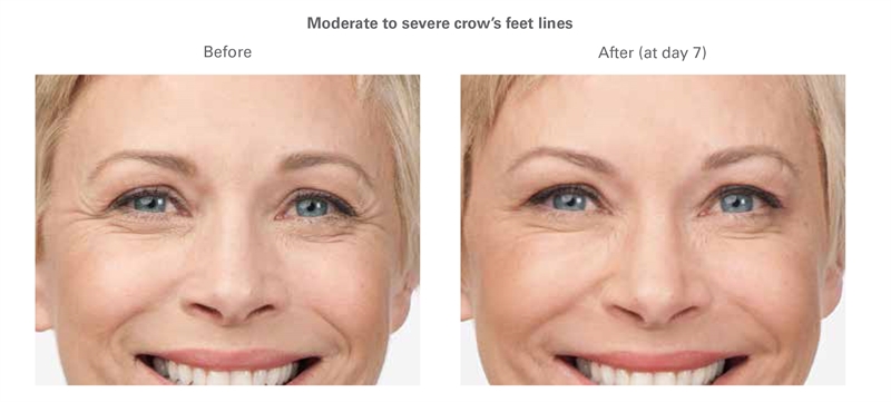 Orlando Botox Before & After - Gentle Touch