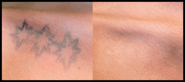 Laser Tattoo Removal - Gentle Touch MediSpa