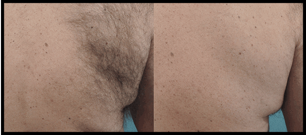 Orlando Laser Hair Removal Before & After - Gentle Touch