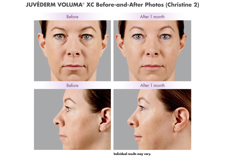 Orlando Juvederm Voluma Before & After - Gentle Touch