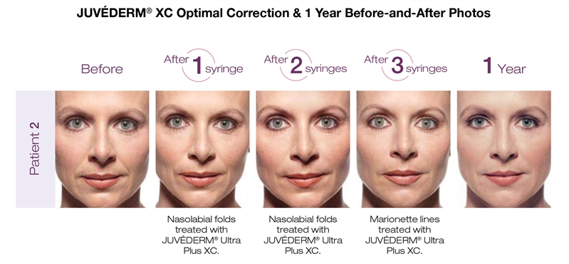 Orlando Juvederm Before & After - Gentle Touch