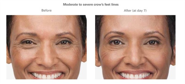 Orlando Botox Before & After - Gentle Touch