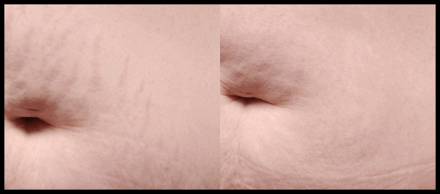 Orlando Stretch Marks Treatments Before & After - Gentle Touch