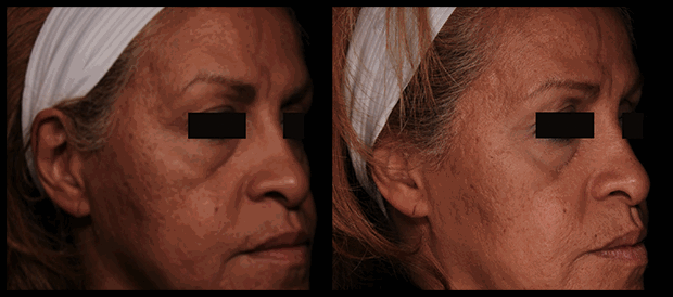 Orlando Acne and Surgical Scar Treatment Before & After - Gentle Touch