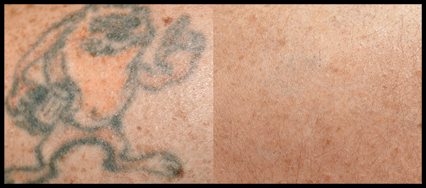 Orlando Laser Tattoo Removal Before & After - Gentle Touch