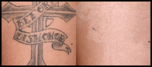 Orlando Laser Tattoo Removal Before & After - Gentle Touch