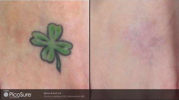 Orlando Laser Tattoo Removal Before & After - Gentle Touch
