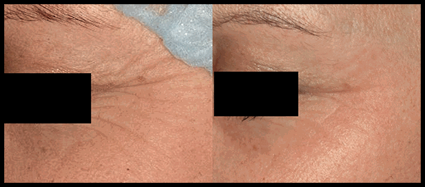 Orlando Skin Revitalization Before & After - Gentle Touch