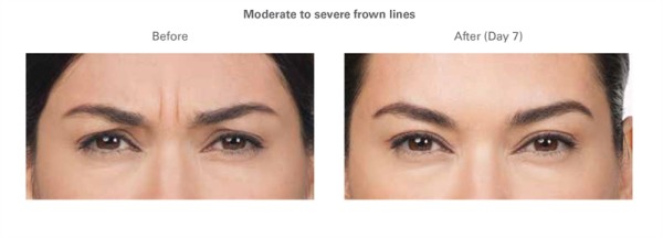 Orlando Botox Before & After - Gentle Touch