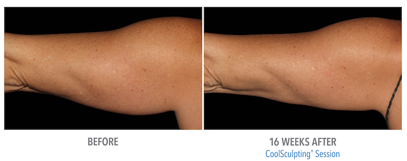 Coolsculpting-before-and-after-arms - Gentle Touch MediSpa