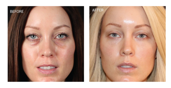 PRF for dark circles