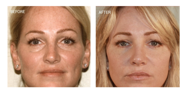 PRF Under-Eye-Treatment