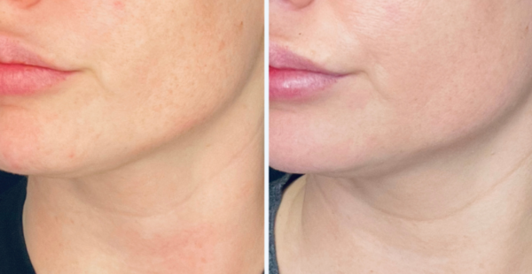 COOLPEEL BEFORE AFTER PICTURES visual data 4
