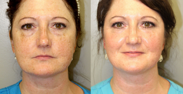 COOLPEEL BEFORE AFTER PICTURES visual data 5